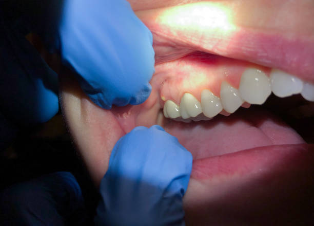 Best Emergency Dentist for Knocked-Out Tooth in North Hartsville, SC